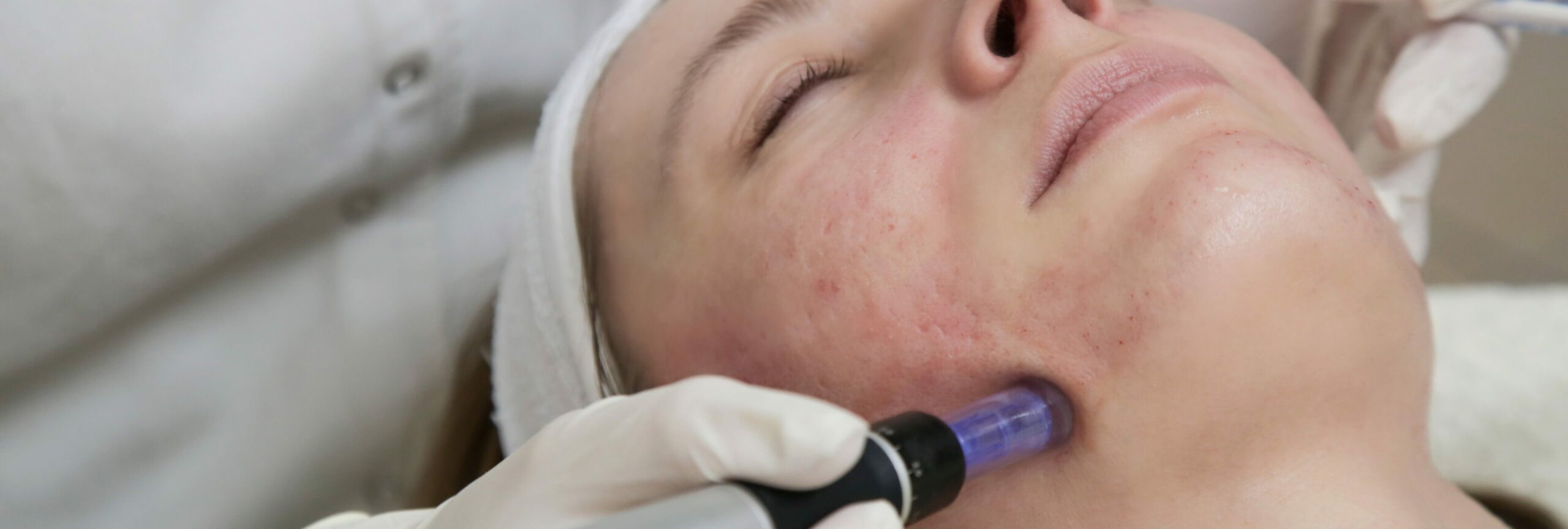 All things microneedling